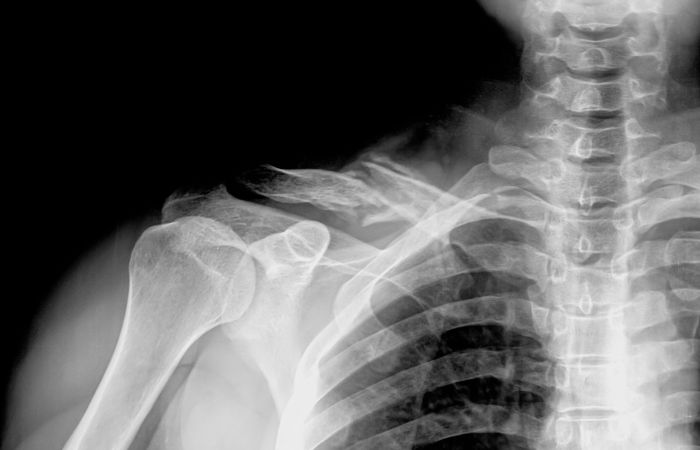 Preparing for a Shoulder X-ray